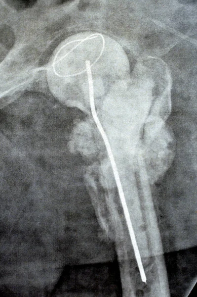 Plain X ray hip joint show left trans cervical fracture of the head of femur with temporary antibiotic loader spacer antibiotic-loaded bone cement after removal of Dynamic Hip Screw after inflammation