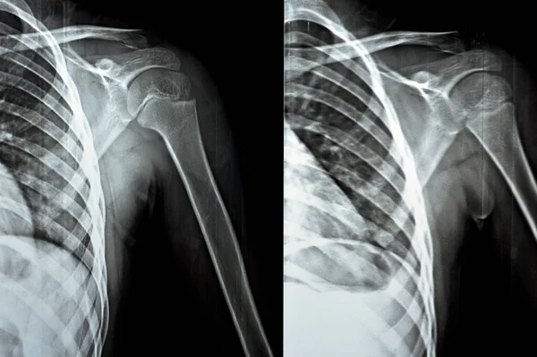 Plain Ray Pxr Left Shoulder Skeletally Immature Female Patient Child — Stock Photo, Image