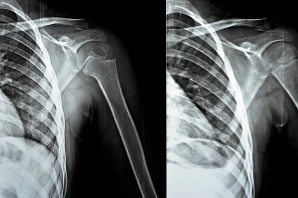 stock image Plain x Ray PXR of left shoulder of skeletally immature female patient child showing lateral one third fracture clavicle, broken lateral part of the clavicle bone of 9 years old girl, selective focus