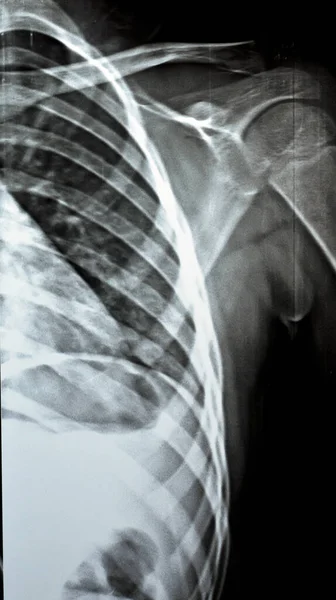 Plain Ray Pxr Der Linken Schulter Eines Skelettal Unreifen Patientenkindes — Stockfoto