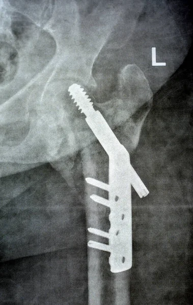 Dhsによって固定された大腿骨骨折の左股間の子宮頸部の首動的ヒップねじ 古い患者の平野X線Pxr 大腿骨頭椎整形外科デバイスは 大腿骨頸部骨折の治療に使用されます — ストック写真