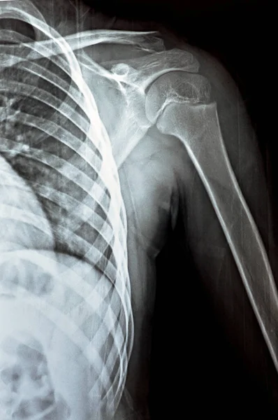 Plain Ray Pxr Der Linken Schulter Eines Skelettal Unreifen Patientenkindes — Stockfoto