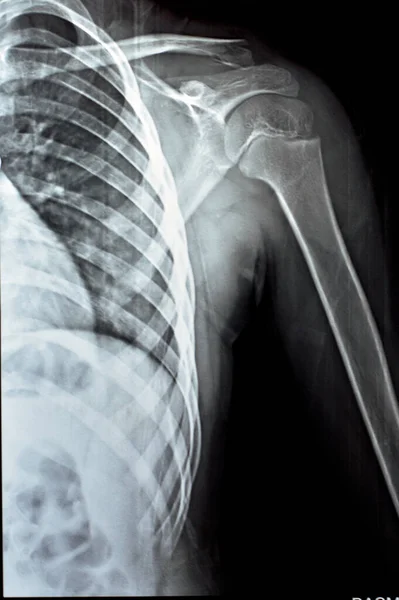 Raio Simples Rxp Ombro Esquerdo Uma Criança Paciente Esqueleticamente Imatura — Fotografia de Stock