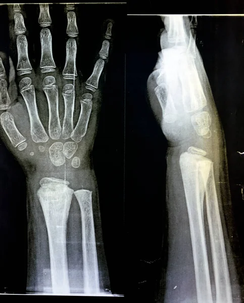 Skelet Gibi Olgunlaşmamış Bir Kadın Hastanın Sağ Bilek Ekleminde Bulunan — Stok fotoğraf