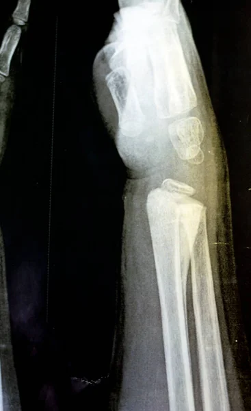 비장성 미성숙 어린이 환자의 오른쪽 관절의 사진은 오른쪽 폐쇄성 폐기종 — 스톡 사진