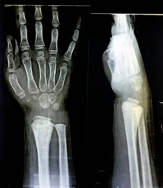 Рівний Рентгенівський Промінь Правого Зап Ястя Скелетного Незрілого Пацієнта Дітей — стокове фото