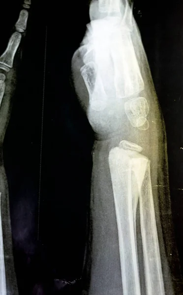 Рівний Рентгенівський Промінь Правого Зап Ястя Скелетного Незрілого Пацієнта Дітей — стокове фото