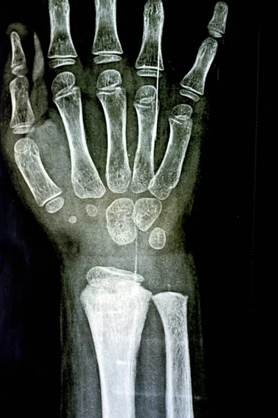 Raio Simples Pxr Articulação Punho Direito Paciente Criança Esqueleticamente Imatura — Fotografia de Stock