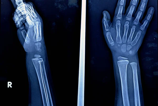 骨性未成熟女童右腕关节Pxr平片X线片显示右侧远端桡骨被忽略的植入性损伤 生长板损伤或有选择性病灶 — 图库照片