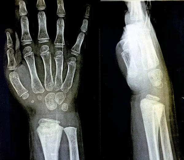 Skelet Gibi Olgunlaşmamış Bir Kadın Hastanın Sağ Bilek Ekleminde Bulunan — Stok fotoğraf