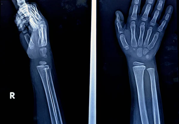 骨格系未成熟女性小児患者の右手首関節のPxrプレーンX線は 右半径骨の無視されたフィシールド損傷を示しています 成長プレートの損傷 またはフィシス 選択的焦点 — ストック写真
