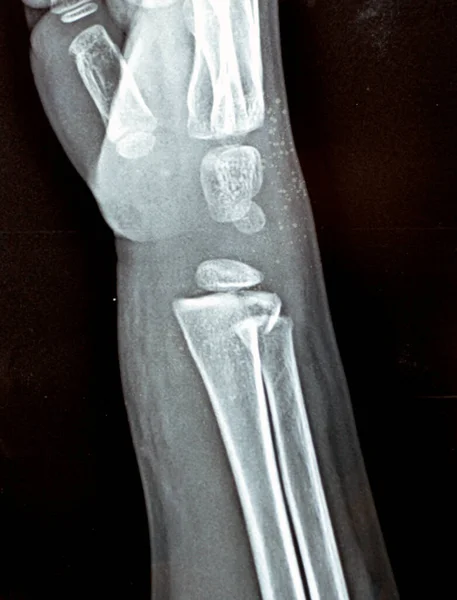Una Radiografía Simple Pxr Articulación Muñeca Derecha Paciente Del Niño — Foto de Stock