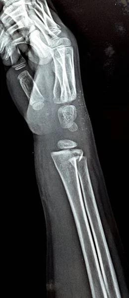 Una Radiografía Simple Pxr Articulación Muñeca Derecha Paciente Del Niño — Foto de Stock