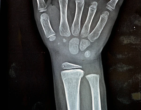Pxr Prostý Rentgen Pravého Zápěstí Kloubu Skeletálně Nezralé Ženy Dětský — Stock fotografie