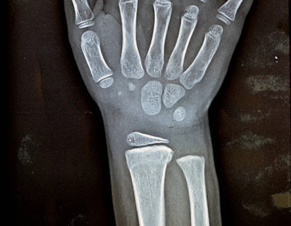 Raio Simples Pxr Articulação Punho Direito Paciente Criança Esqueleticamente Imatura — Fotografia de Stock