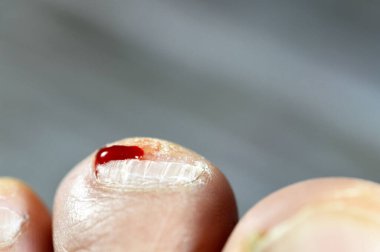 Sol ayağın ikinci parmağında kanama, ayak parmağına hakaret, tedavi ve bandaj gerektiren kanayan bir yaraya neden olma, ayak tırnağında tıbbi yardıma ihtiyacı olan kan, seçici bir odaklanma.