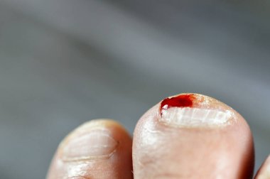 Sol ayağın ikinci parmağında kanama, ayak parmağına hakaret, tedavi ve bandaj gerektiren kanayan bir yaraya neden olma, ayak tırnağında tıbbi yardıma ihtiyacı olan kan, seçici bir odaklanma.