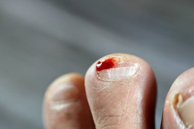 Sol ayağın ikinci parmağında kanama, ayak parmağına hakaret, tedavi ve bandaj gerektiren kanayan bir yaraya neden olma, ayak tırnağında tıbbi yardıma ihtiyacı olan kan, seçici bir odaklanma.