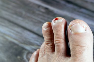 Sol ayağın ikinci parmağında kanama, ayak parmağına hakaret, tedavi ve bandaj gerektiren kanayan bir yaraya neden olma, ayak tırnağında tıbbi yardıma ihtiyacı olan kan, seçici bir odaklanma.