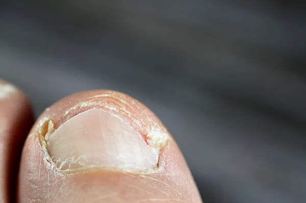 Ingrown toenail of the big toe of the foot is a common condition in which the corner or side of a toenail grows into the soft flesh result in pain, inflamed skin, swelling and infection