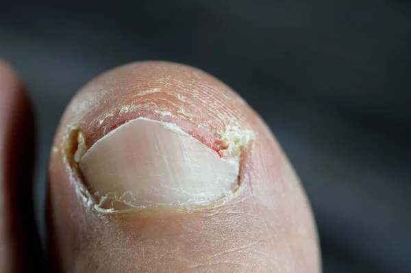 Ingrown toenail of the big toe of the foot is a common condition in which the corner or side of a toenail grows into the soft flesh result in pain, inflamed skin, swelling and infection