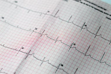 EKG Elektrokardiyografide sağ ventriküler hipertropinin sinüs ritmi anormalliği, hipertrop ve iskemiye bağlı alt T dalgası, anormal EKG çalışması, onaylanmamış teşhis