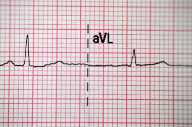 EKG Elektrokardiyografide sağ ventriküler hipertropinin sinüs ritmi anormalliği, hipertrop ve iskemiye bağlı alt T dalgası, anormal EKG çalışması, onaylanmamış teşhis