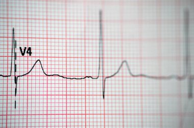 EKG Elektrokardiyografide sağ ventriküler hipertropinin sinüs ritmi anormalliği, hipertrop ve iskemiye bağlı alt T dalgası, anormal EKG çalışması, onaylanmamış teşhis