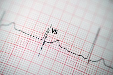 EKG Elektrokardiyografide sağ ventriküler hipertropinin sinüs ritmi anormalliği, hipertrop ve iskemiye bağlı alt T dalgası, anormal EKG çalışması, onaylanmamış teşhis