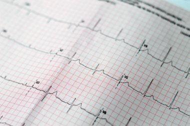 ECG ElectroCardioGraph paper that shows sinus rhythm abnormality of right ventricular hypertrophy, inferior T wave due to hypertrophy and ischemia, Abnormal ECG study, unconfirmed diagnosis clipart