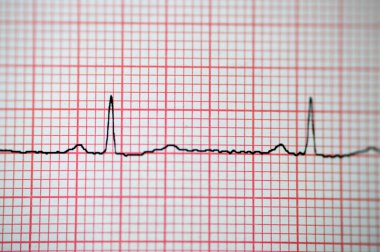 EKG Elektrokardiyografide sağ ventriküler hipertropinin sinüs ritmi anormalliği, hipertrop ve iskemiye bağlı alt T dalgası, anormal EKG çalışması, onaylanmamış teşhis