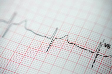 EKG Elektrokardiyografide sağ ventriküler hipertropinin sinüs ritmi anormalliği, hipertrop ve iskemiye bağlı alt T dalgası, anormal EKG çalışması, onaylanmamış teşhis