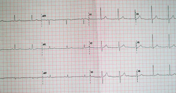 Ecg Electrocardiograph Paper Shows Sinus Rhythm Annormality Right Ventricular Hypertrophy — Photo