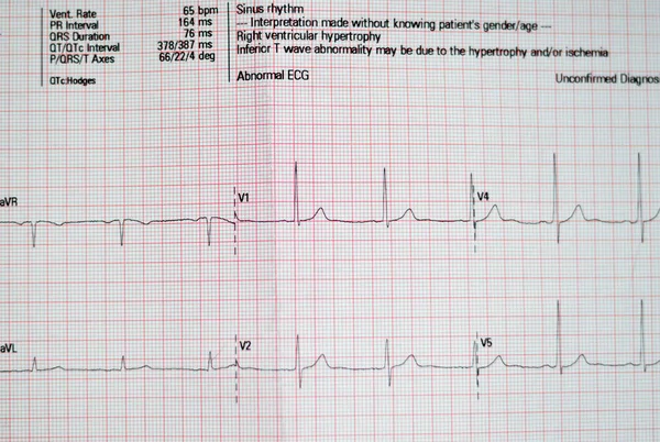 Ecg Electrocardiograph Paper Shows Sinus Rhythm Anormality Right Ventricular Hypertrophy —  Fotos de Stock