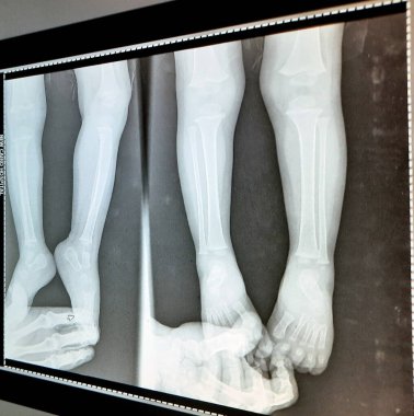 Sade x Ray PXR sağ ve sol ayak, ayak bilekleri ve ayakları, iskelet olarak olgunlaşmamış erkek çocuk 18 ay boyunca ebeveynler tarafından düzeltilmiş.