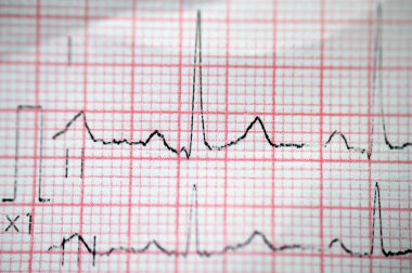 Elektrokardiyogram EKG, kalbin elektriğini çeken, kalp durumu ve ritmi hakkında fikir veren ve anjin pektorisi ya da miyokardiyal enfarktüsü olmayan bir grafiktir.