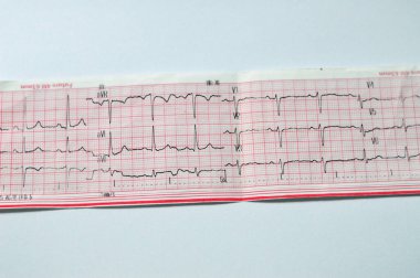 Elektrokardiyogram EKG, kalbin elektriğini çeken, kalp durumu ve ritmi hakkında fikir veren ve anjin pektorisi ya da miyokardiyal enfarktüsü olmayan bir grafiktir.