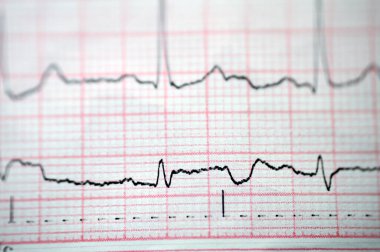 Elektrokardiyogram EKG, kalbin elektriğini çeken, kalp durumu ve ritmi hakkında fikir veren ve anjin pektorisi ya da miyokardiyal enfarktüsü olmayan bir grafiktir.