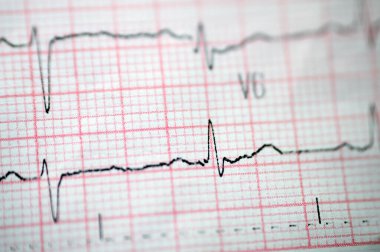 Elektrokardiyogram EKG, kalbin elektriğini çeken, kalp durumu ve ritmi hakkında fikir veren ve anjin pektorisi ya da miyokardiyal enfarktüsü olmayan bir grafiktir.