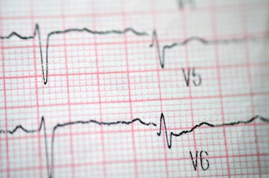 Elektrokardiyogram EKG, kalbin elektriğini çeken, kalp durumu ve ritmi hakkında fikir veren ve anjin pektorisi ya da miyokardiyal enfarktüsü olmayan bir grafiktir.