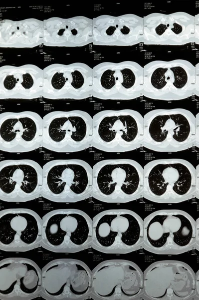 Компьютерная Томография Грудной Клетки Несколькими Срезами Показывающая Нормальное Исследование Нормальную — стоковое фото