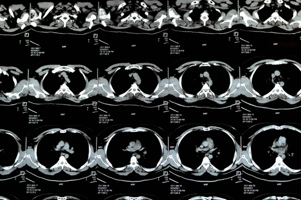 Багатопроменеве Сканування Грудної Клітини Показує Нормальне Дослідження Нормальний Вигляд Легень — стокове фото