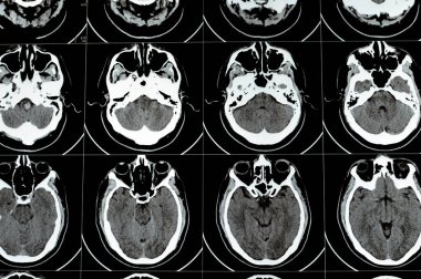 Beyin tomografisinde geniş beyin sapı ve sağ merkezde semiovale hematom, normal arka fossa yapıları, ventriküler sistemin normal boyutları ve orta hat yapıları görülüyor.