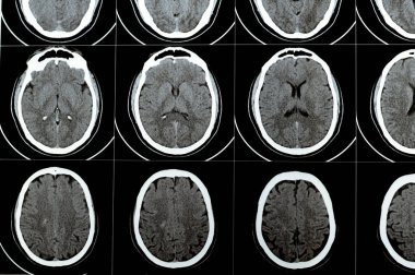 Beyin tomografisinde geniş beyin sapı ve sağ merkezde semiovale hematom, normal arka fossa yapıları, ventriküler sistemin normal boyutları ve orta hat yapıları görülüyor.