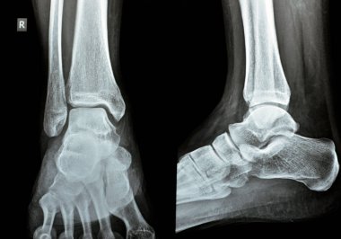 Sağ ayak bileğinin yan görüntüsü sindesmotik bilek burkulması, distal tibiyofibular sendesmosis, yüksek bilek burkulması, burkulması, bilek burkulması gibi bir kaç bağ zedelenmesi.