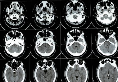 Beyin tomografisinde geniş beyin sapı ve sağ merkezde semiovale hematom, normal arka fossa yapıları, ventriküler sistemin normal boyutları ve orta hat yapıları görülüyor.