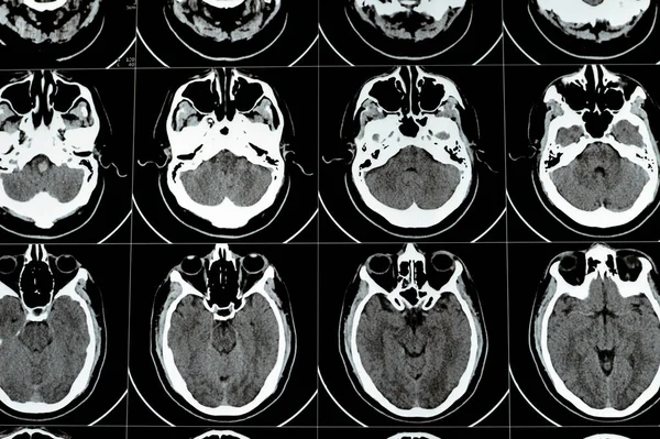 stock image Multi slice CT scan of the brain showing Large brain stem and right centrum semiovale hematoma, normal posterior fossa structures, normal size of ventricular system and central mid-line structures