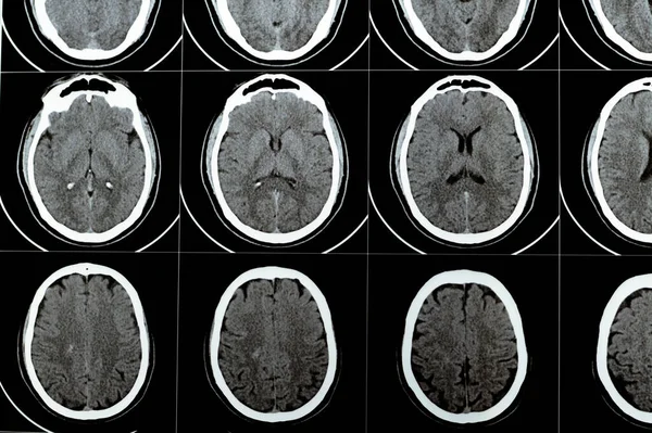 stock image Multi slice CT scan of the brain showing Large brain stem and right centrum semiovale hematoma, normal posterior fossa structures, normal size of ventricular system and central mid-line structures