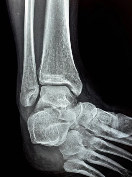 Plain x-ray mortise view of the right ankle showing syndesmotic ankle sprain, an injury to one or more of ligaments comprising the distal tibiofibular syndesmosis, high ankle sprain, twisted ankle