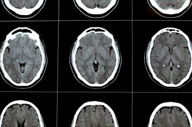 Beyin tomografisi beyin tomografisi gösteriyor ki beyin sapması, sağ merkezde semiovale gelişimsel venöz anomali, serebral hematom, medulla oblongata ve pontomedullary bağlantı noktalarında soluk yoğunlukta lezyon.